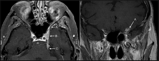 Foramen Rotundum Mri