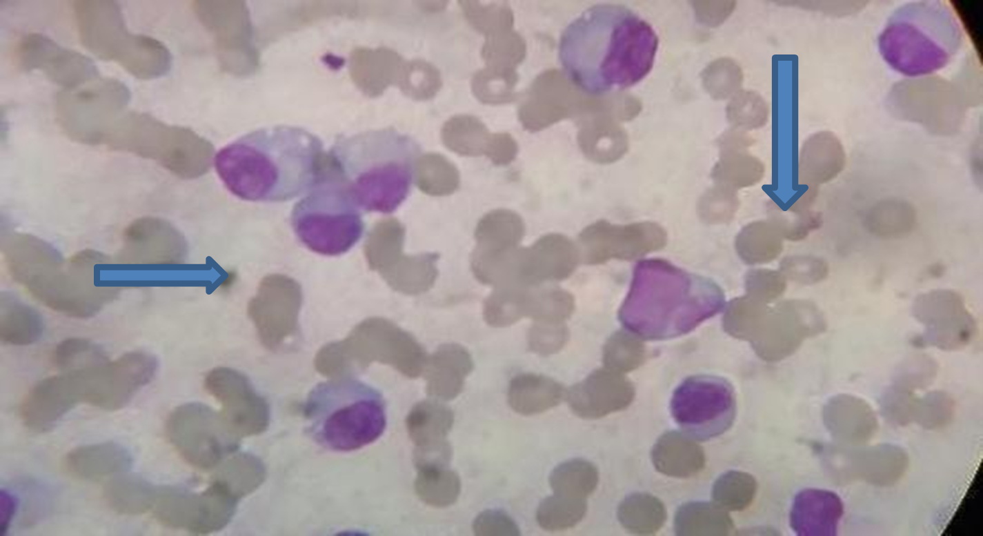 plasma cell leukemia