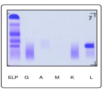 Lambda Light Chain Multiple Myeloma