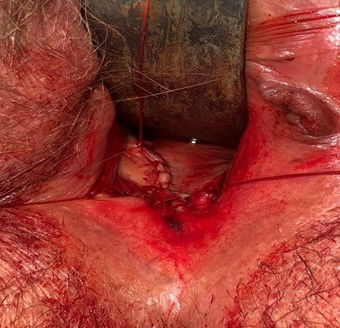 Vaginal mass with necrotic appearance obstructing the vaginal